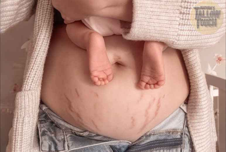 Nature’s Touch Luxe Mother’s Recovery Body Cream | Pregnancy-Safe
Whipped Tallow Formula for Stretch Marks + Postpartum Skin Renewal