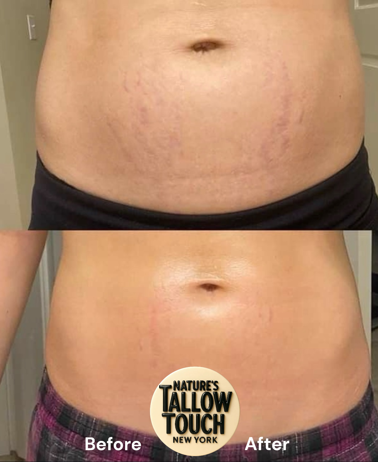 Mother’s Recovery Tallow Body Cream | Dry Skin-Elasticity + Stretch-Mark & Discoloration support - Nature’s Tallow Touch LLC